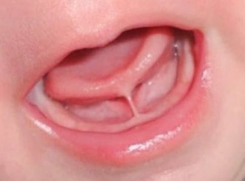 tongue tie in baby